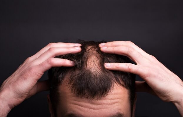 عشر خطوات لزيادة كثافة الشعر للرجال