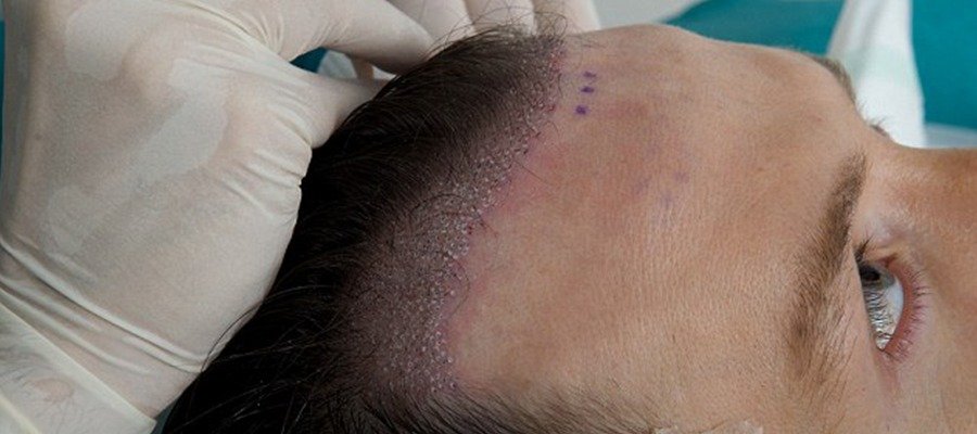 Why is Turkey the best in hair transplantation?
